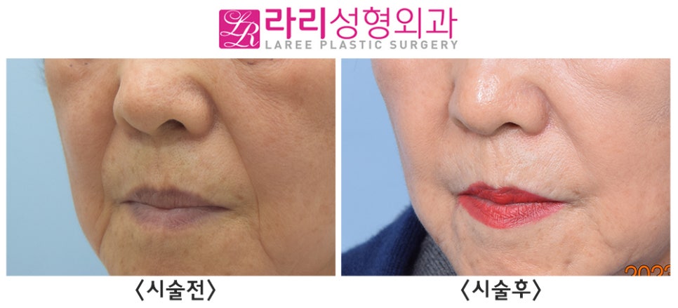 [라리성형외과] 거상수술 없이 필러시술로 팔자주름(+마리오네트주름) 펴주기 (사진 有) 관련 이미지 2