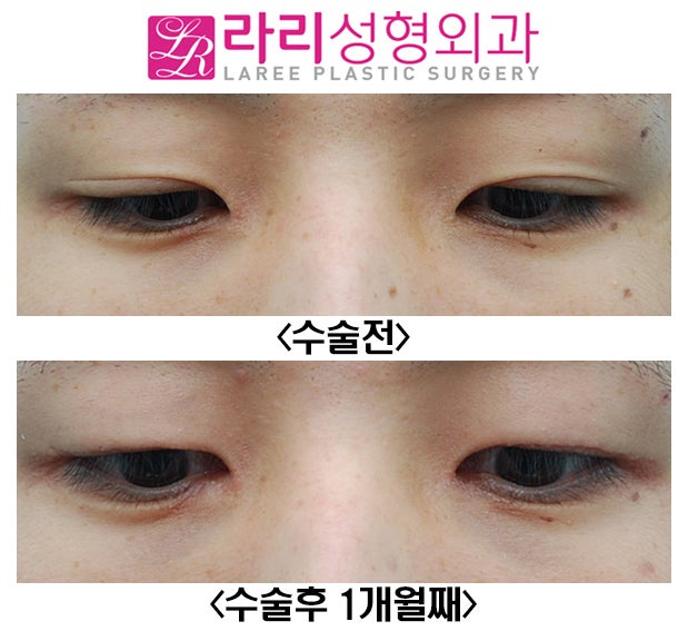 [Rari Plastic Surgery] Removing Double Eyelids Without a Crease and Medial Canthoplasty Are Effective for Changing the Look image 5