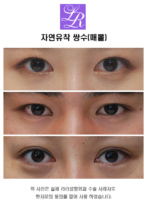 자연유착 쌍꺼풀잘하는곳, 다양한 케이스를 보여준다면 관련 이미지 1