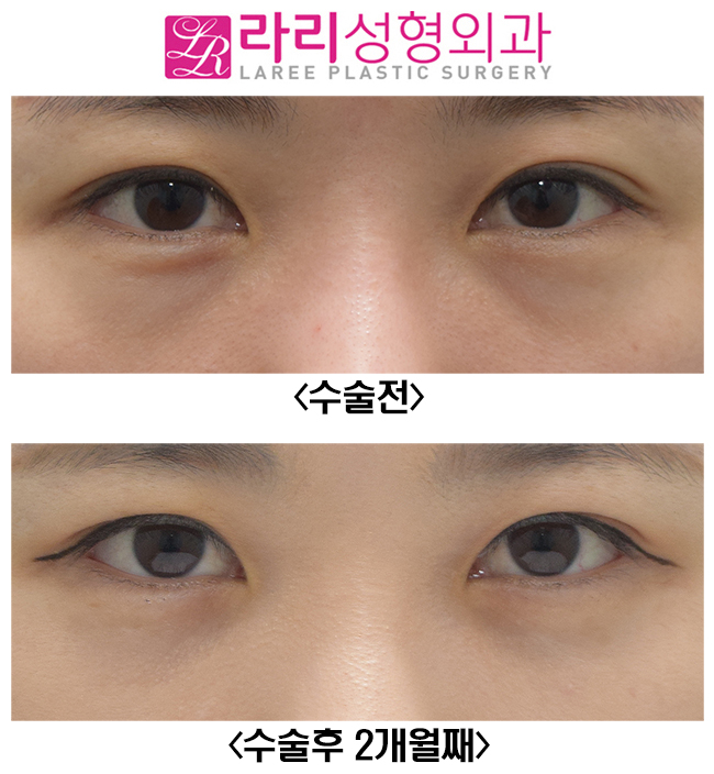 [라리성형외과] 다크서클, 필러? 지방이식? 말고 눈밑지방재배치수술 관련 이미지 1