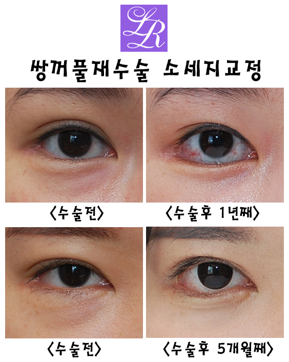 쌍꺼풀재수술 왜 필요한거죠? 라인교정, 붓기, 경과, 흉터교정 관련 이미지 4