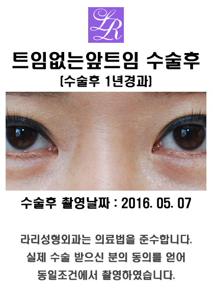 몽고주름제거하는 앞트임 - 갈고리 모양 교정 관련 이미지 7