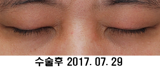 Before and After: Sharper Male Eye Correction (feat. Video) image 12