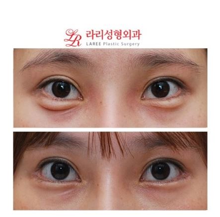 눈꼬리내리기뒤트임/뒷트임 재수술 전후사진 관련 이미지 1