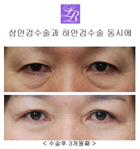 상안검수술, 하안검수술- 수술전후, 경과 궁금쓰 관련 이미지 8