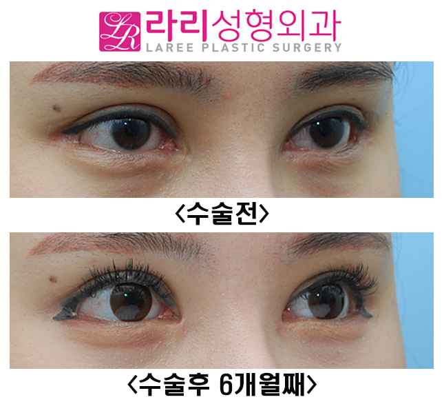 [라리성형외과] 적당한 앞트임 복원, 복원수술 전후 모양 관련 이미지 2