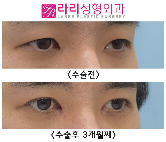 [라리성형외과] 붓기 최소화하는 자연스러운 속쌍꺼풀 남자 절개눈매교정 앞트임수술 전후사진 관련 이미지 1