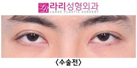 [라리성형외과] 쌍꺼풀없애기 수술 눈안감김(토안)의 원인이 정말 피부절제 때문일까? - 무절제쌍꺼풀없애기 관련 이미지 17