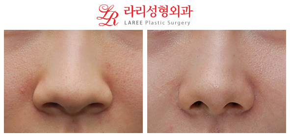 [Lari Plastic Surgery] Nose Surgery / Alar Reduction 4-Year Long-Term Follow-Up Before-and-After Photos image 2