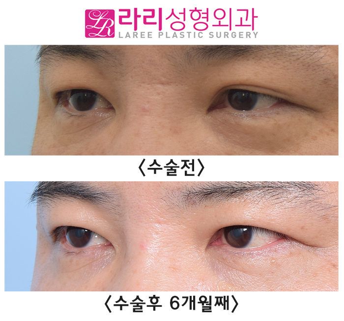 [Rari Plastic Surgery] Before and After Surgery to Remove Uneven Natural Double Eyelids Accompanied by Sagging Skin image 3