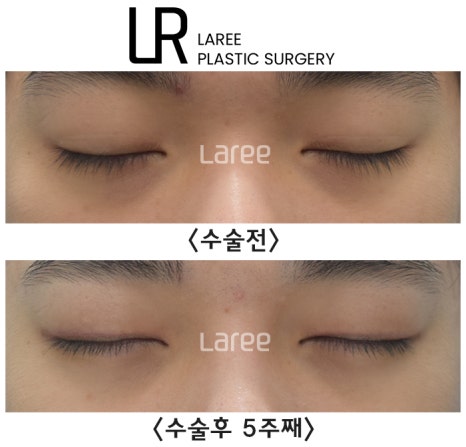 [라리성형외과] 쌍꺼풀수술은 괜찮은데 쌍꺼풀없애는수술은 괜찮지 않다고 ? 관련 이미지 3