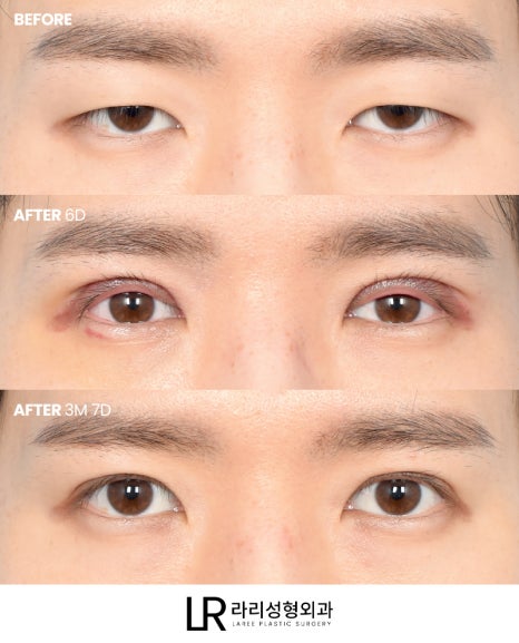 [Lari Plastic Surgery] Swelling After Double Eyelid Surgery: Why Does It Go Down Differently on Each Side? Will It Eventually Even Out? image 7
