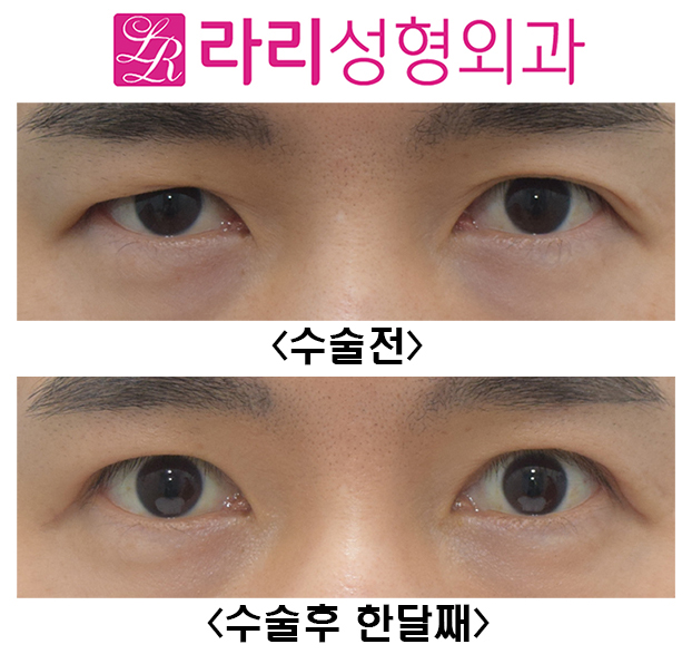 [Larie Plastic Surgery] Surgery to Remove Double Eyelids and Short-Term One-Month Progress Before and After Eye Correction Surgery image 2