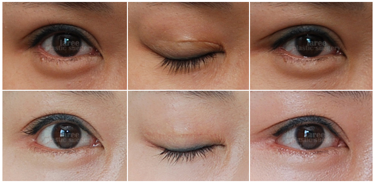 At Lari, Revision Epicanthoplasty Corrects Outer Canthotomy Scars! image 2
