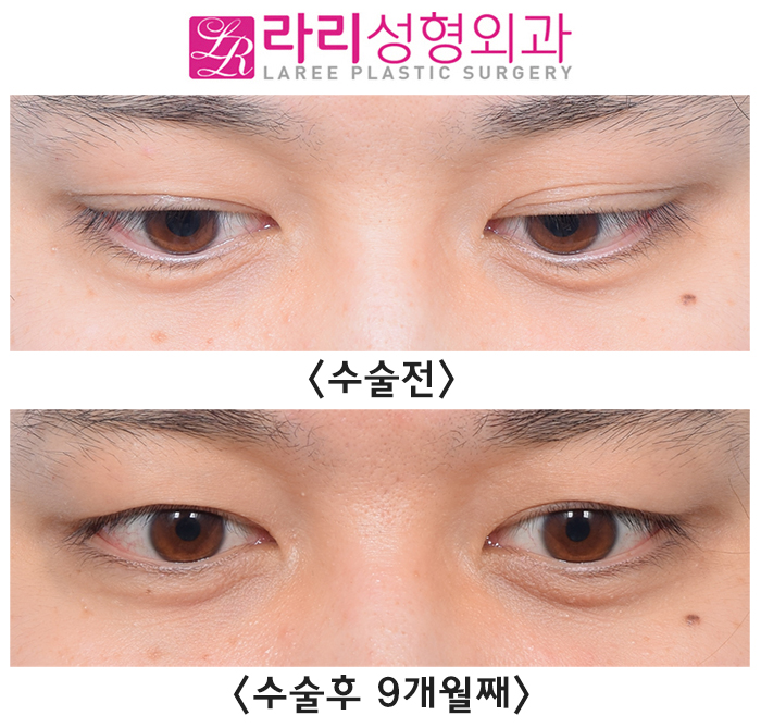 [Rari Plastic Surgery] Natural-looking eyelid correction surgery before-and-after photos that can look natural at any gaze angle (+forehead Botox) image 2