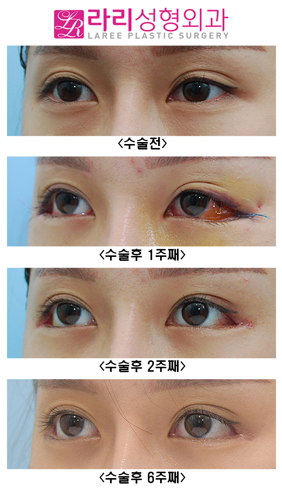 [Rari Plastic Surgery] Recovery Process of Non-Incisional Eye Correction Swelling image 3