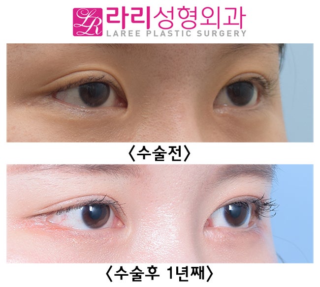 [Lari Plastic Surgery] Effective Revision Epicanthoplasty and Revision Canthoplasty: I Did Not Have Double Eyelid Surgery! image 2