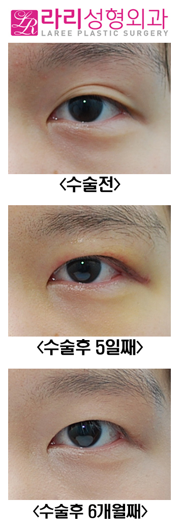 [Rari Plastic Surgery] Thick Natural Double Eyelid Removal Surgery: Before and Up to 6 Months After image 1