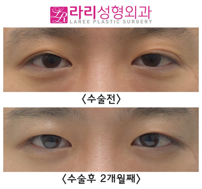 [Rari Plastic Surgery] Before-and-After Photos of Surgery to Remove a Folded Double Eyelid After Incisional Double Eyelid Surgery image 2