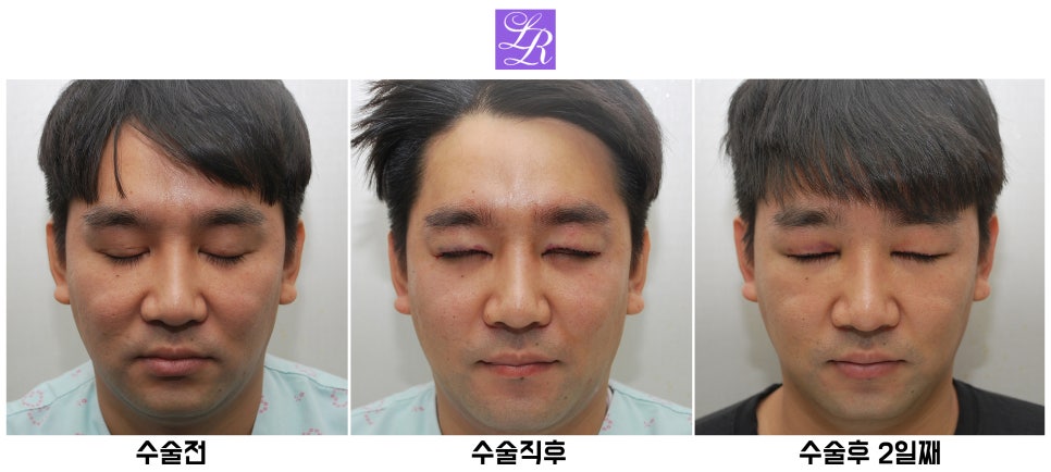 Review of Double Eyelid Reversal Surgery - Day 2 After Surgery, Swelling After Double Eyelid Surgery image 2