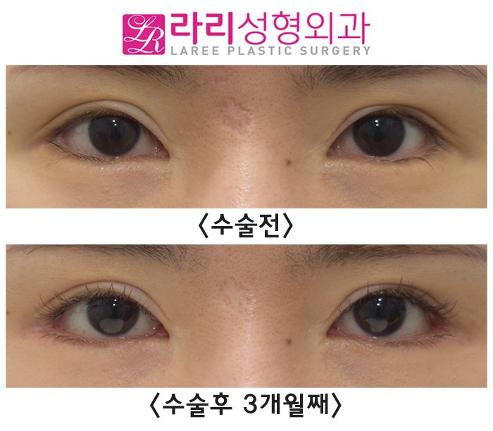[라리성형외과] 완성도 높은 뒤트임수술을 위해 애교이식지방은 제거해 주세요. (필요시 안검내반수술을 함께) 관련 이미지 1
