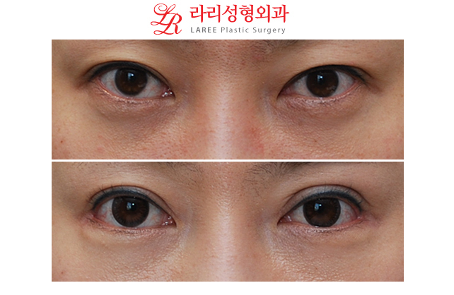 쌍꺼풀재수술 눈꼬리내리기뒤트임/눈꼬리내리기뒷트임 전후사진-※ 관련 이미지 3