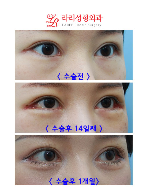 뒷트임재수술, 눈밑지방재배치 콜라보 관련 이미지 4