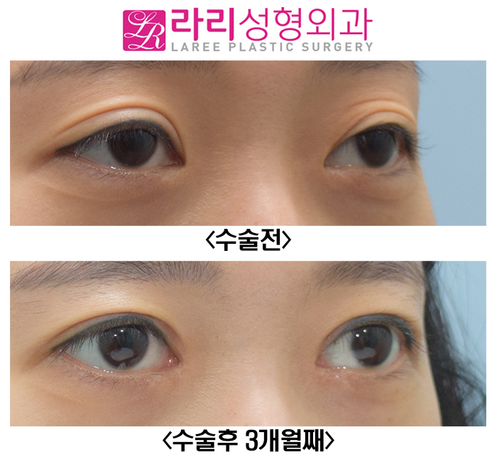 [Rari Plastic Surgery] Reoperation for a Loosened Double Eyelid, with Ptosis Correction image 3