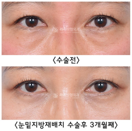 [라리성형외과] 하안검성형 VS 눈밑지방재배치(제거) : 어떤 수술을 해야 할까? 관련 이미지 5