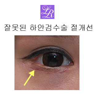 상안검수술, 하안검수술- 수술전후, 경과 궁금쓰 관련 이미지 4