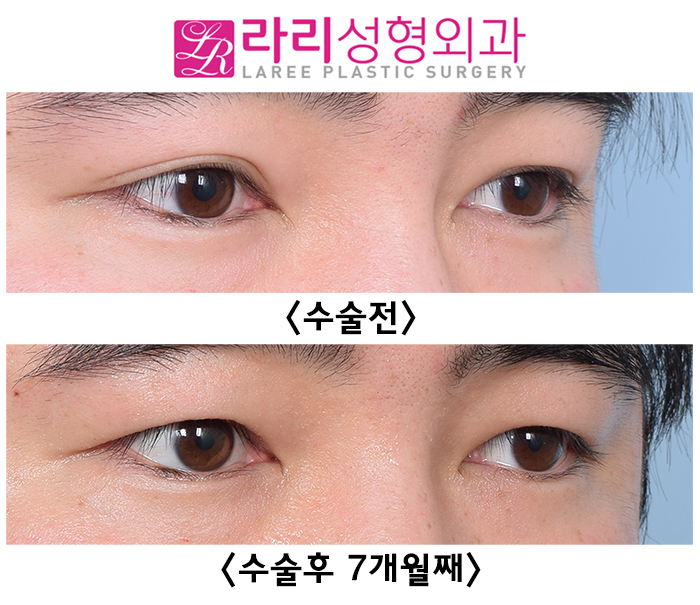 [라리성형외과] 자연쌍꺼풀 비대칭 교정 쌍꺼풀없애기 수술 전후 사진 관련 이미지 2