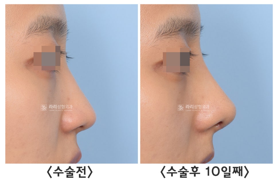 [라리성형외과] 자가늑연골을 이용한 여러 가지 코 수술 : 고난이도 코성형의 핵심 재료 관련 이미지 7