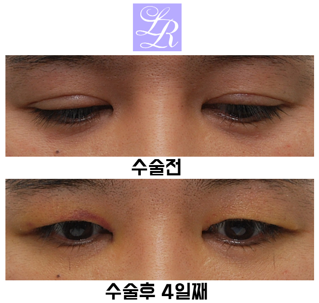 Review of Double Eyelid Reversal Surgery - Day 4 After Surgery, Swelling After Double Eyelid Surgery image 5