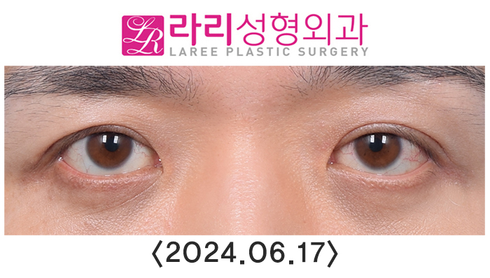 [Lari Plastic Surgery] Double Eyelid Removal Surgery and Upper Eyelid Fat Grafting Surgery: Comparing Recovery and Swelling Over 6 Months image 4