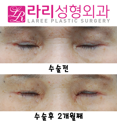 눈앞쪽 여러겹 쌍거풀없애기+뾰족한누호 둥글게 만들기 관련 이미지 6