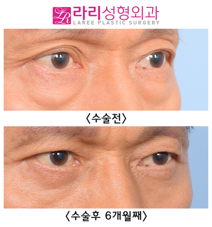 [Lari Plastic Surgery] Correction Surgery Before and After for Old Double Eyelid Surgery Side Effects, Sagging Skin, and Multiple Folded Double Eyelids image 3