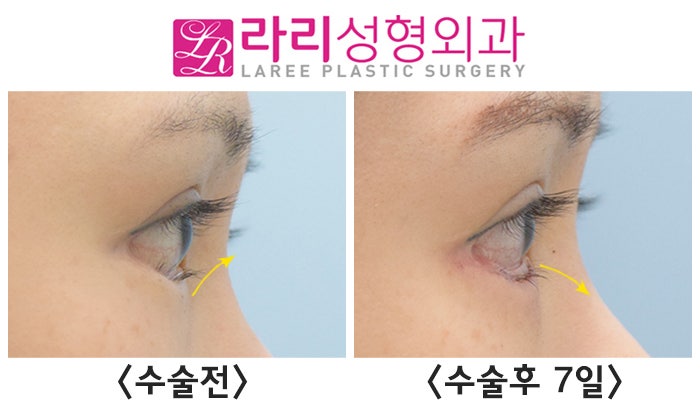 [라리성형외과] 안검내반과 안검외반, 무엇이 다를까 ? 관련 이미지 4