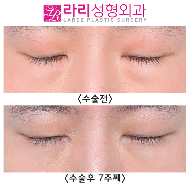 [Lari Plastic Surgery] Check for Undetected Under-Eye Fat and Solve It with Under-Eye Fat Repositioning. image 2
