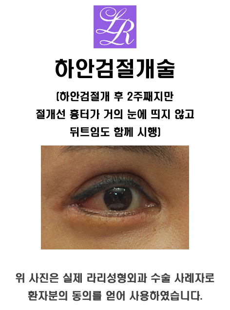 안검내반의 주증상은 속눈썹 찔림 - 수술 교정 관련 이미지 4