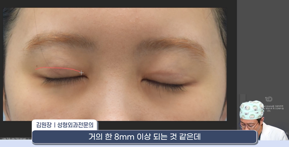[라리성형외과] 쌍꺼풀재수술 라인 낮추는 두 가지 수술법 (절제방법 , 두줄따기방법) 관련 이미지 13