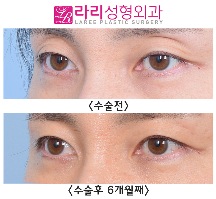 [라리성형외과] 절개쌍꺼풀없애기 + 윗눈꺼풀지방이식, 6개월 차 수술 전후 경과 사진 관련 이미지 2