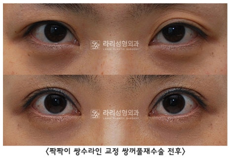 [라리성형외과] 쌍꺼풀수술 그리고 쌍꺼풀재수술 , 성공하려면 어디서 해야 할까요 !? 관련 이미지 6