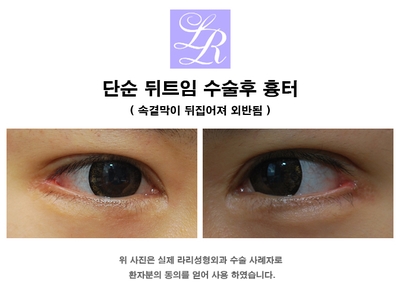 Detailed Explanation of the Principle of Lateral Canthoplasty and Eye Corner Lowering Surgery image 2