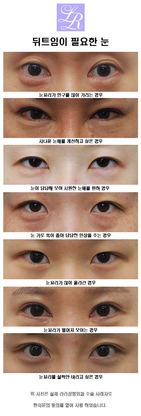 외안각고정술 뜻 - 뒤트임의 한 방법이죠 관련 이미지 4