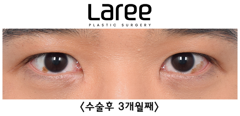 [Lari Plastic Surgery] Eyelid Correction Surgery and Upper Canthoplasty: Experiencing the Maximum Effect of Non-Double-Eyelid Eyelid Correction Without Medial Drooping image 4
