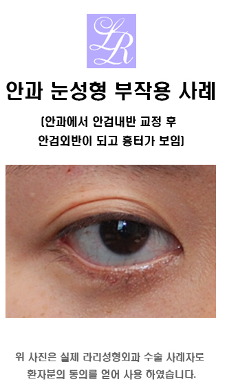 뒤트임재수술 - 안검내반 교정, 2주와 4개월, 1년 경과 관련 이미지 6