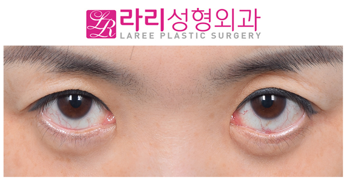 [Laree Plastic Surgery] If Ectropion Has Occurred, Let’s Find Out the Right Time for Correction image 3