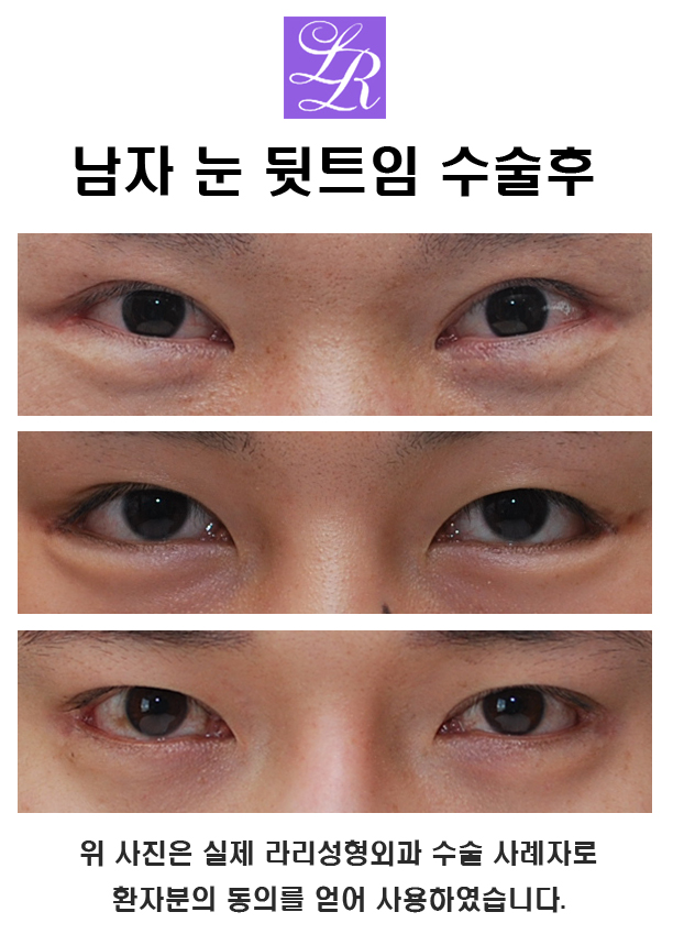 남자 눈도 뒷트임 할 수 있나요? 관련 이미지 6