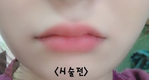 How to Make the Corners of the Mouth Lift Beautifully with Lip Corner Filler image 14