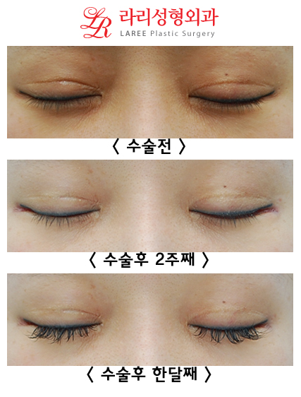 8-Year Long-Term Follow-Up vs. 2-Week Short-Term Follow-Up in the Same Patient (Lateral Canthoplasty & Revision Lateral Canthoplasty) image 5